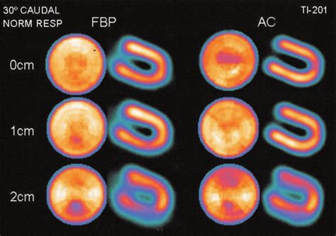 Interaction of attenuation artifact and respiratory motion artifact.... | Download Scientific ...