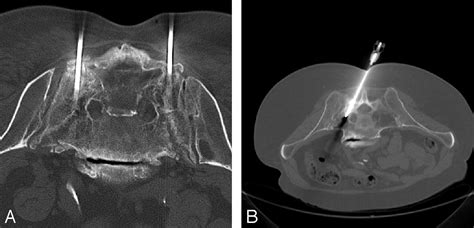 Sacroplasty by CT and Fluoroscopic Guidance: Is the Procedure Right for Your Patient? | American ...