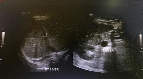 Ultrasound showing hepatomegaly without evidence of biliary obstruction ...