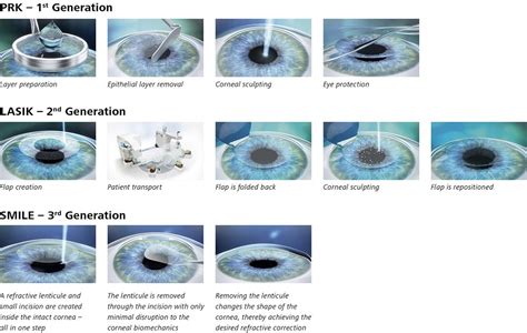 What Are The Differences Similarities Between LASIK SMILE, 05/20/2023