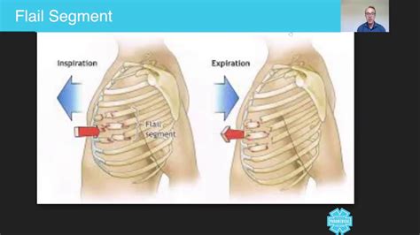 Flail Segment - Australian Paramedical College - YouTube