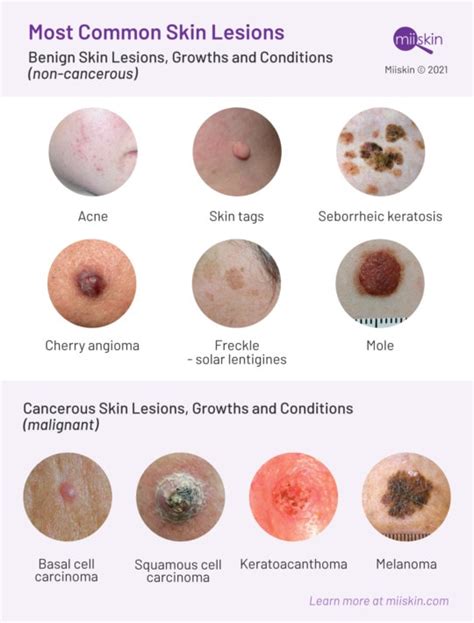 Skin Lesions: Types, Pictures & Prevention