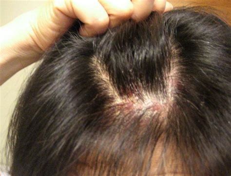 Itchy Scalp - Symptoms, Hair loss, Causes, Treatment | HubPages