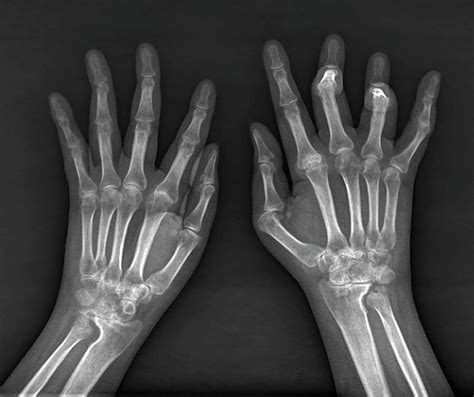 Rheumatoid Arthritis Of The Hands Photograph by Zephyr/science Photo ...