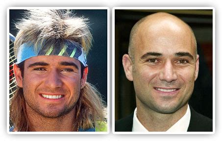 In the News – Andre Agassi Wore a Wig – WRassman,M.D. BaldingBlog