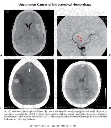 Uncommon Causes of Intracerebral Hemorrhage