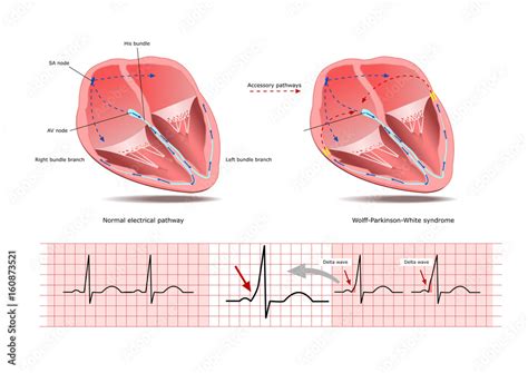 The Wolff-Parkinson-White (WPW) syndrome, a condition of altered electrical signaling, and two ...