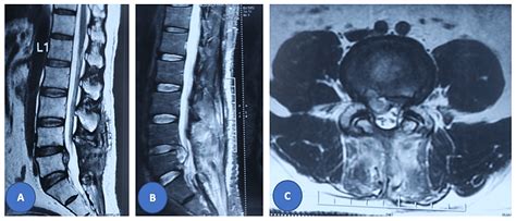 Functional Outcomes After Discectomy for Recurrent Lumbar Herniation ...