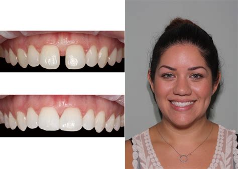 Palm Beach Smiles - Cosmetic Dentistry & 6 Month Braces: Do You Mind the (Tooth) Gap?