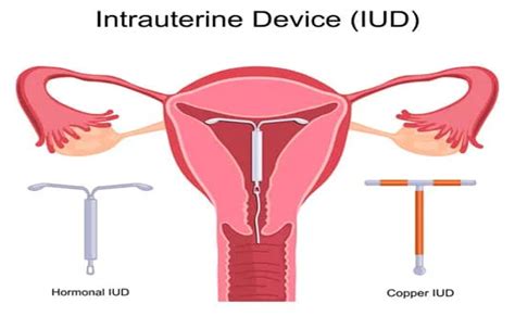 Uterine Coil