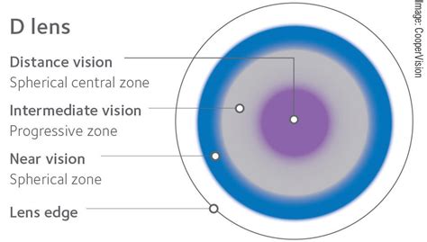 Add Multifocals to Your Myopia Toolbox