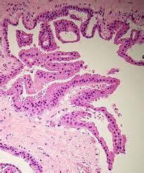 Understanding Apocrine Metaplasia: Causes, Symptoms, and Treatment Options - CuriousQuill