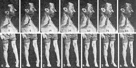 Primary Torsion Dystonia | Genetics and Genomics | JAMA Neurology ...