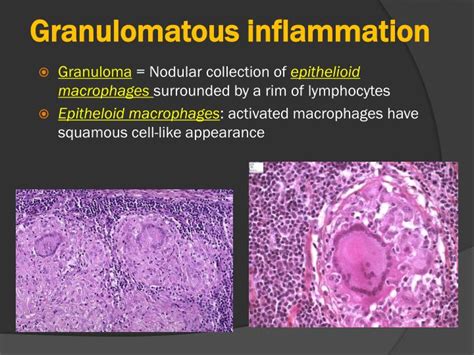 PPT - GRANULOMATOUS INFLAMMATION PowerPoint Presentation - ID:2374733