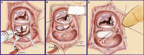 Repair of Partial Atrioventricular Septal Defect: Age and Outcomes ...