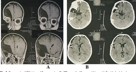 Figure 3 from Management of subdural hygroma in infants and children | Semantic Scholar