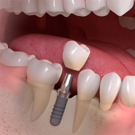 Single And Multiple Teeth Implants Sydney - Ryde | Gladesville | North Ryde | Parramatta ...