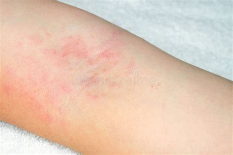 Allergy To Red Rash on the Arms Stock Photo - Image of allergy, epidermis: 75537888