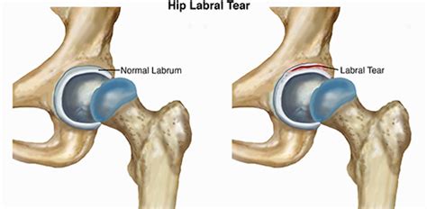 Hip Labral Tear - 8 Proven Exercises To Alleviate Hip Pain - Integrative Spine & Sports