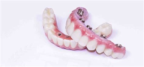 What are dental implants made of - Dental News Network