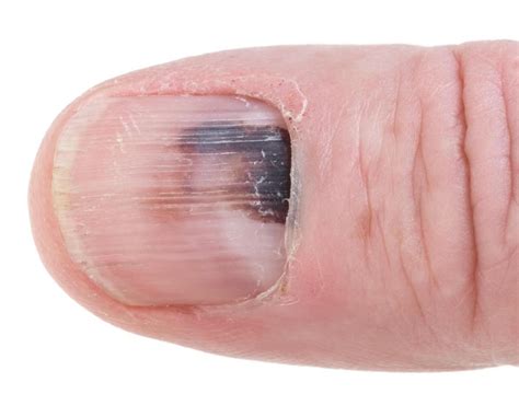 What Are the Different Types of Thumb Injuries? (with pictures)