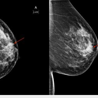 Diagnostic Mammogram following Ultrasound-guided Biopsy A diagnostic... | Download Scientific ...