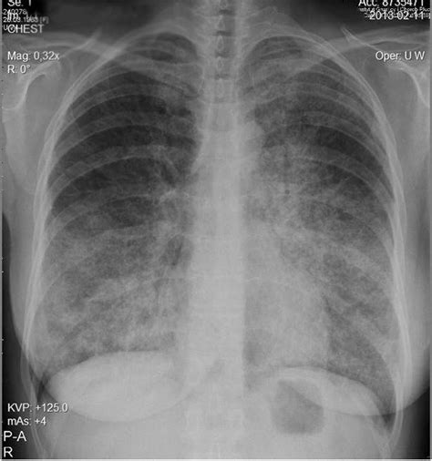 Figure 1 from Pulmonary alveolar proteinosis during a 30-year ...