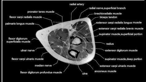 MRI Read Elbow Joint Axial view||MRI axial cross sectional anatomy of Elbow Joint - YouTube