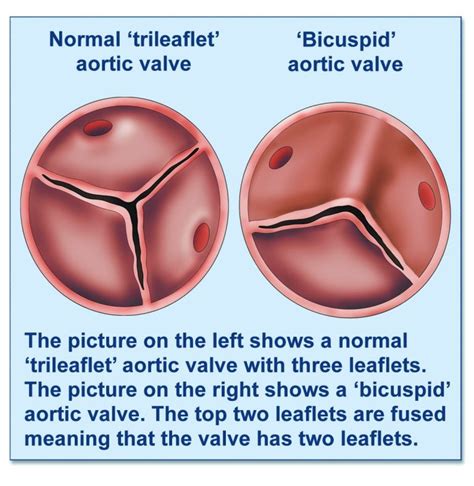 Bicuspid aortic valve - British Heart Valve Society