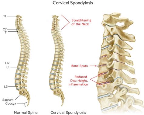 Cervical Spondylosis - Causes, Symptoms, Exercises, Treatment