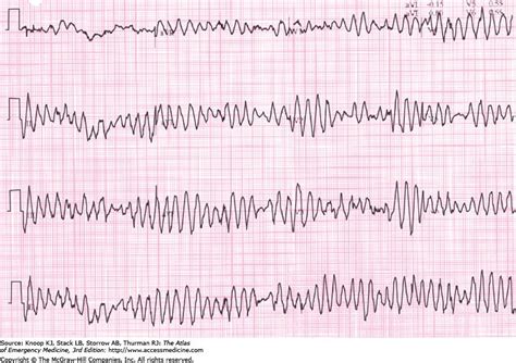 Torsades de pointes. Funny name. Serious trouble. Ekg Interpretation ...