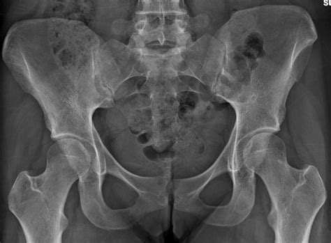 High Energy Trauma Pelvis | Radiology | U of U School of Medicine