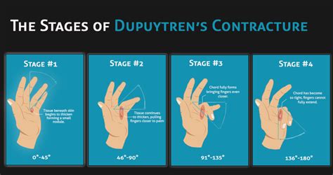 Dupuytren’s Contracture Treatment Methods - Bút Chì Xanh