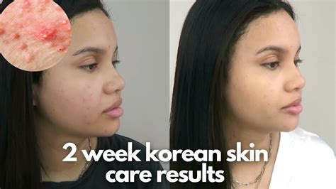 Korea's newest beauty trend: dewy honey skin 🍯 2 Week Before & After | Annie Nova - YouTube