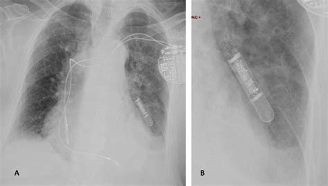 Implanted Cardiac Loop Recorder