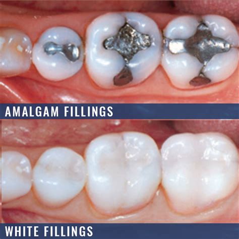 white-fillings-amalgam-fillings | Benson Dental Practice