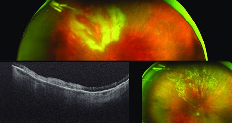 Toxoplasma retinochoroiditis in an immunocompromised patient ...