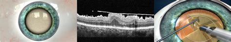 Combined Surgery for Epiretinal Membrane - Retina Doctor