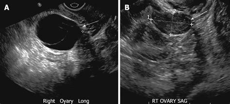 Ovarian Daughter Cyst Ultrasound