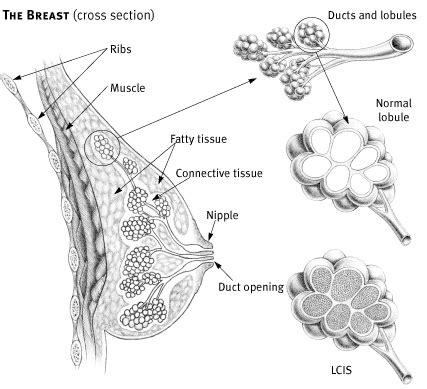 Lobular Carcinoma in Situ - Cancer Council Victoria