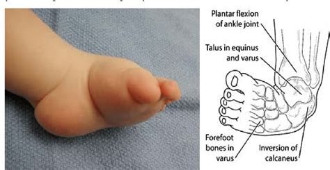 CONGENITAL TALIPES EQUINOVARUS (CTEV) - PHYSIOFEEDS