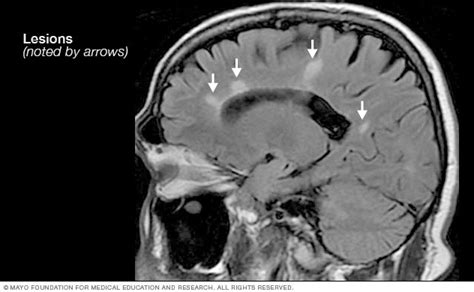 Multiple sclerosis MRI scan - Mayo Clinic