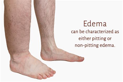 Edema Definition Pathophysiology Causes Clinical Features Images