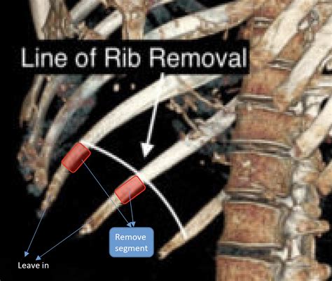 is Rib Ostectomy As Good As Rib Removal In Waistline Narrowing Surgery? - Plastic Surgeon | Dr ...