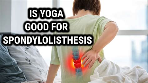 Is Yoga Good For Spondylolisthesis - Best Yoga Therapy for ...