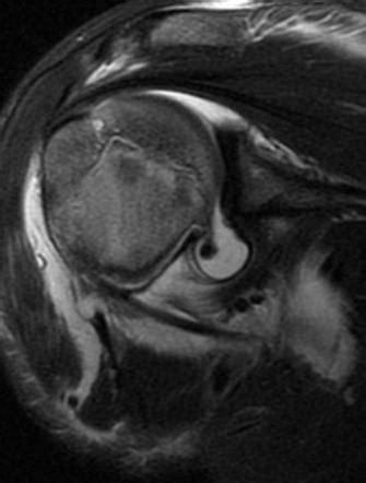 J sign (shoulder) | Radiology Reference Article | Radiopaedia.org