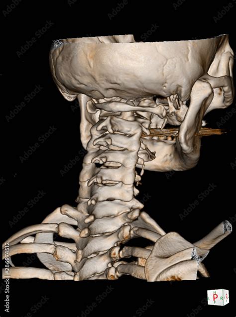 CT Scan cervical spine 3 D render and X-ray C-spine finding Reverse ...