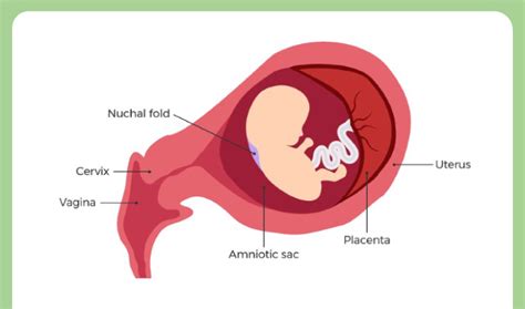 Nuchal Fold Thickness: Normal or abnormal? Expert insights in 2023