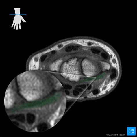 Wrist MRI: Interpretation, landmarks, anatomy | Kenhub