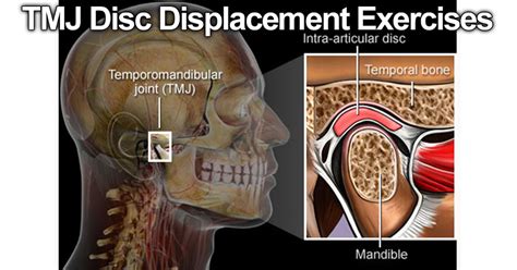 TMJ Disc Displacement Exercises – JawFlex®